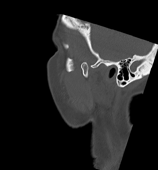 File:Anterior temporomandibular joint dislocation (Radiopaedia 59430-66784 B 5).jpg
