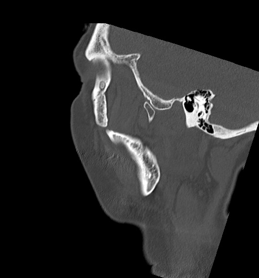Anterior temporomandibular joint dislocation (Radiopaedia 59430-66784 B 54).jpg
