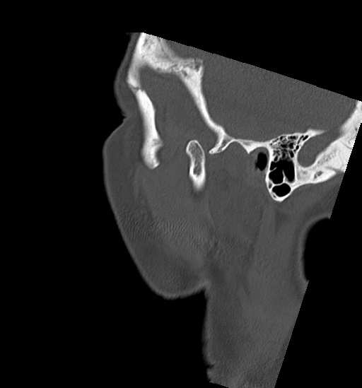 Anterior temporomandibular joint dislocation (Radiopaedia 59430-66784 B 6).jpg
