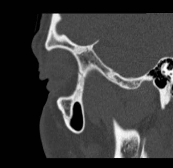 File:Antrochoanal polyp (Radiopaedia 33984-35202 Sagittal bone window 77).jpg