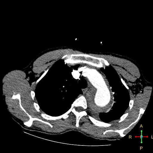 File:Aortic aneurysm and penetrating ulcer (Radiopaedia 23590-23704 A 8).jpg