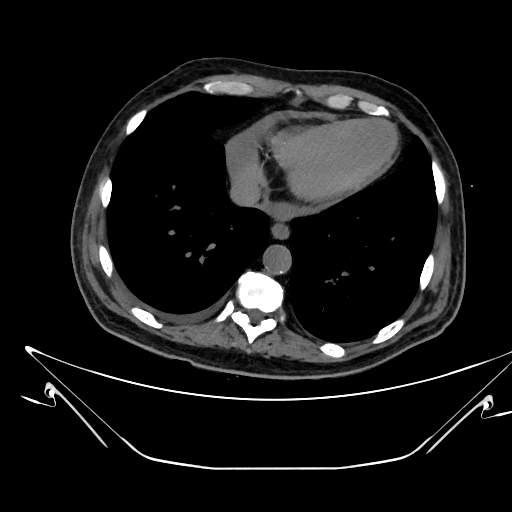 Aortic arch aneurysm (Radiopaedia 84109-99365 Axial non-contrast 208).jpg