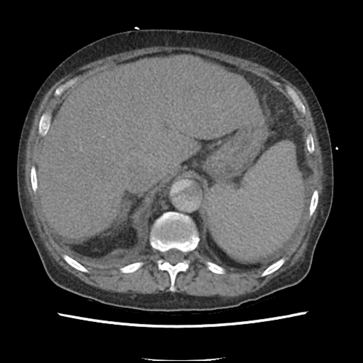 Aortic arch graft infection (FDG PET-CT) (Radiopaedia 71975-82437 A 59).jpg