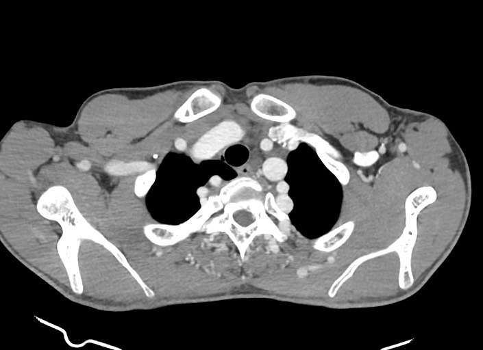 File:Aortic coarctation with aneurysm (Radiopaedia 74818-85828 A 170).jpg