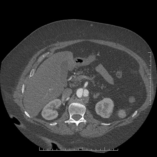 Aortic dissection- Stanford A (Radiopaedia 35729-37268 B 53).jpg