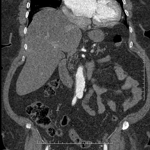File:Aortic dissection- Stanford A (Radiopaedia 35729-37268 F 40).jpg