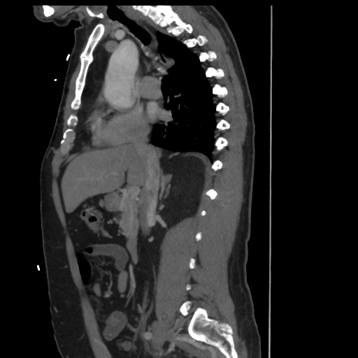 File:Aortic dissection- Stanford A (Radiopaedia 37759-39664 Sagittal C+ delayed 10).png