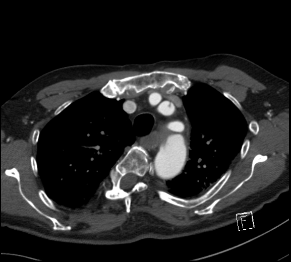 File:Aortic dissection (CTPA) (Radiopaedia 75506-86750 A 24).jpg