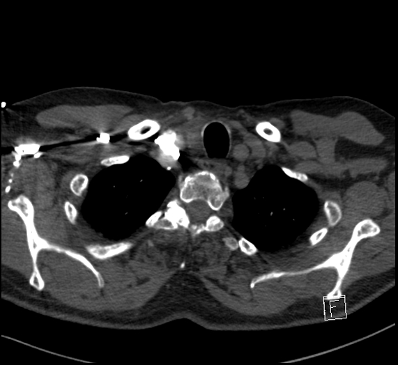 Aortic dissection (CTPA) (Radiopaedia 75506-86751 Axial C+ CTPA 16).jpg