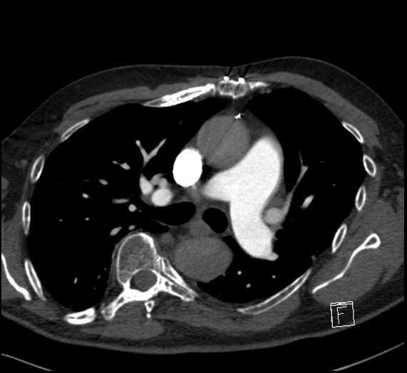 File:Aortic dissection (CTPA) (Radiopaedia 75506-86751 Axial C+ CTPA 61).jpg