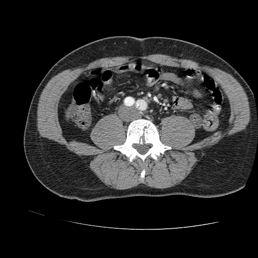 File:Aortic dissection - Stanford A -DeBakey I (Radiopaedia 28339-28587 B 159).jpg