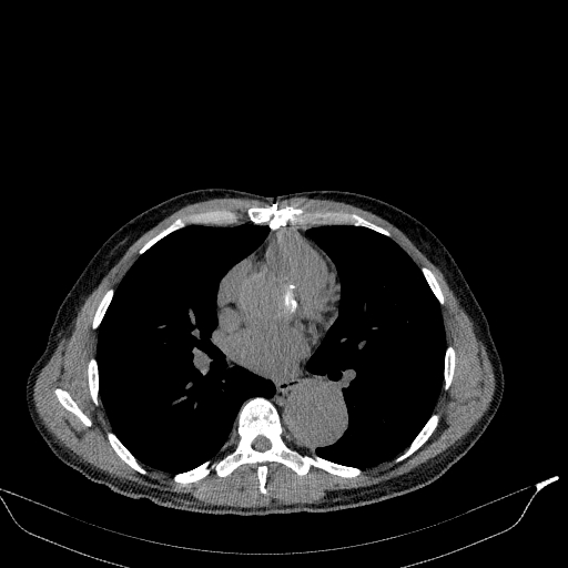 Aortic dissection - Stanford type A (Radiopaedia 83418-98500 Axial non-contrast 23).jpg