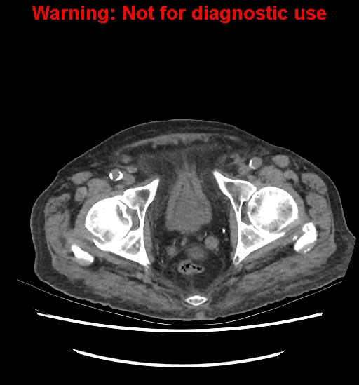 File:Aortic graft infection (Radiopaedia 44979-48907 Axial non-contrast 88).jpg