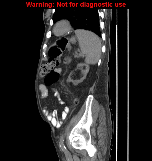 Aortic graft infection (Radiopaedia 44979-48907 C 18).jpg