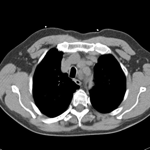 Aortic intramural hematoma (Radiopaedia 31139-31838 Axial non-contrast 13).jpg