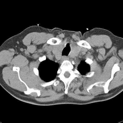 Aortic intramural hematoma (Radiopaedia 31139-31838 Axial non-contrast 6).jpg