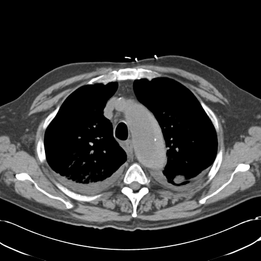 Aortic intramural hematoma (Radiopaedia 34260-35540 Axial non-contrast 18).png