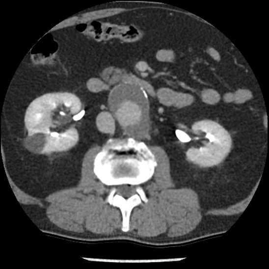 Aortic intramural hematoma (type B) (Radiopaedia 79323-92387 Axial C+ delayed 71).jpg