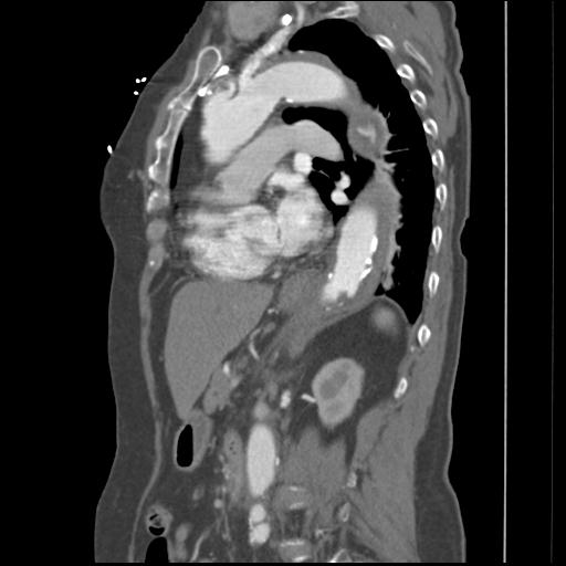 File:Aortic intramural hematoma from penetrating atherosclerotic ulcer (Radiopaedia 31137-31836 B 13).jpg