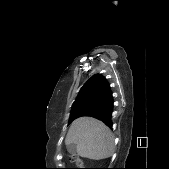 Aortic intramural hematoma with dissection and intramural blood pool (Radiopaedia 77373-89491 D 10).jpg