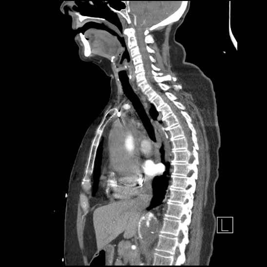 File:Aortic intramural hematoma with dissection and intramural blood pool (Radiopaedia 77373-89491 D 40).jpg