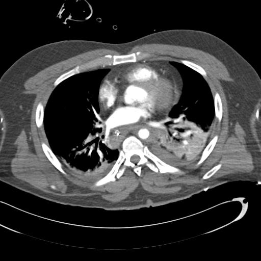 Aortic transection, diaphragmatic rupture and hemoperitoneum in a complex multitrauma patient (Radiopaedia 31701-32622 A 49).jpg