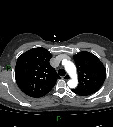 Aortic valve endocarditis (Radiopaedia 87209-103485 C 26).jpg
