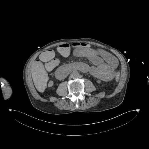 Aortoduodenal fistula (Radiopaedia 75286-86415 Axial non-contrast 37).jpg