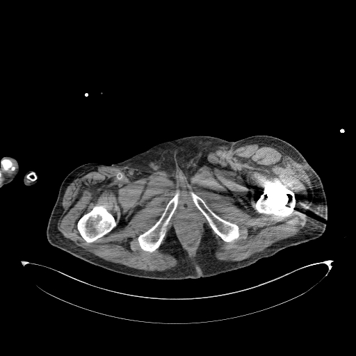 Aortoduodenal fistula (Radiopaedia 75286-86415 Axial non-contrast 83).jpg