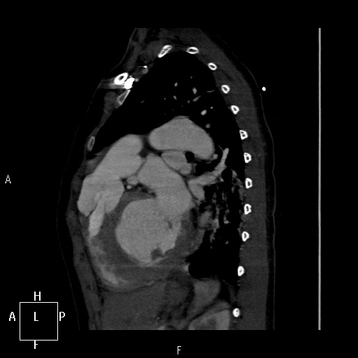 File:Aortopulmonary septal defect (Radiopaedia 41990-45013 Sagittal C+ CTPA 14).jpg