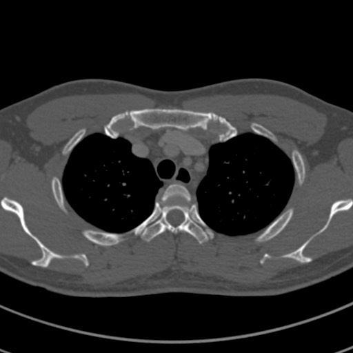 Apical lung mass mimic - neurogenic tumor (Radiopaedia 59918-67521 Axial bone window 17).jpg