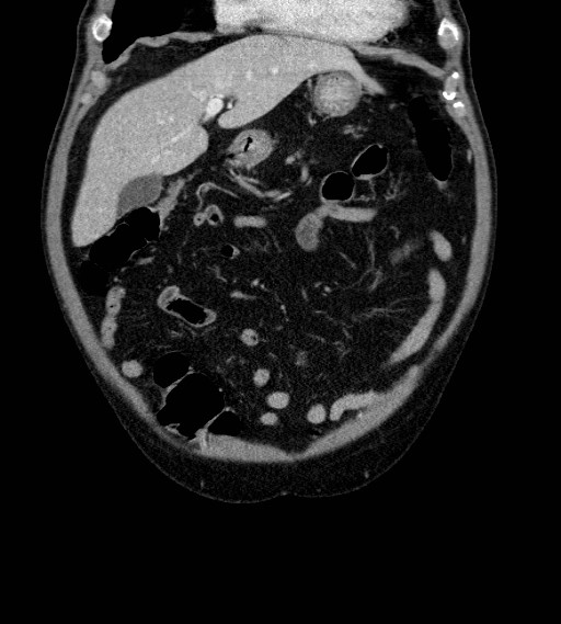 Appendiceal adenocarcinoma complicated by retroperitoneal abscess (Radiopaedia 58007-65039 A 23).jpg