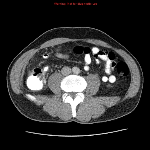 Appendicitis and renal cell carcinoma (Radiopaedia 17063-16760 A 35).jpg