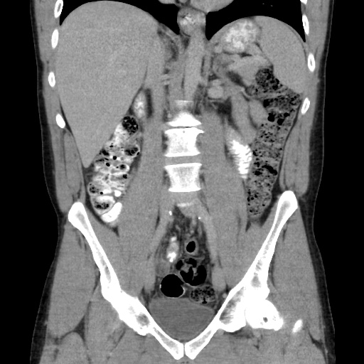 Appendicitis complicated by post-operative collection (Radiopaedia 35595-37113 B 29).jpg