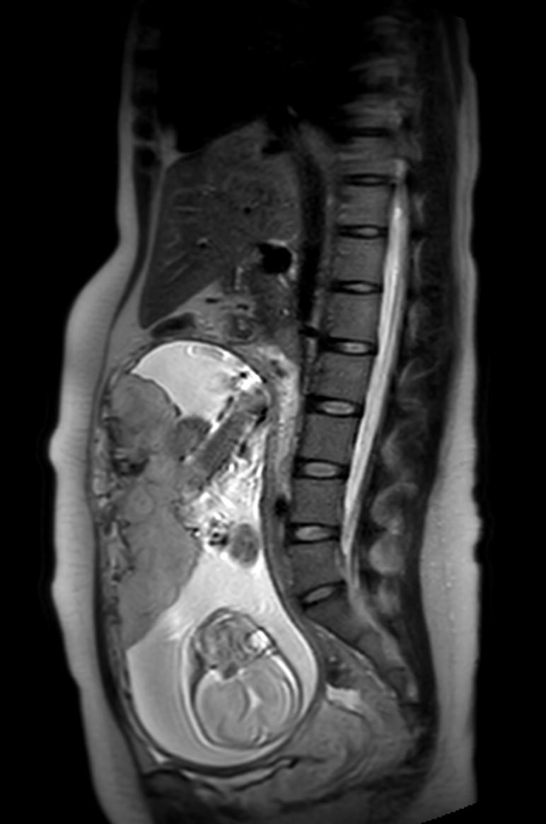 Appendicitis in gravida (MRI) (Radiopaedia 89433-106395 Sagittal T2 35).jpg