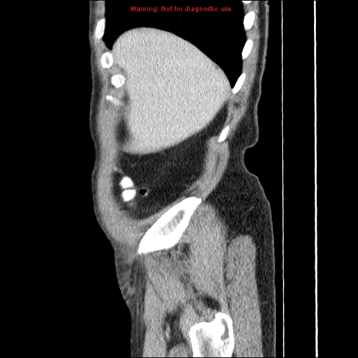 File:Appendicitis mass in inguinal hernia (Radiopaedia 26858-27029 C 3).jpg