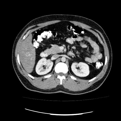 File:Appendicitis with diverticulosis (Radiopaedia 47693-52383 Axial C+ 50).jpg