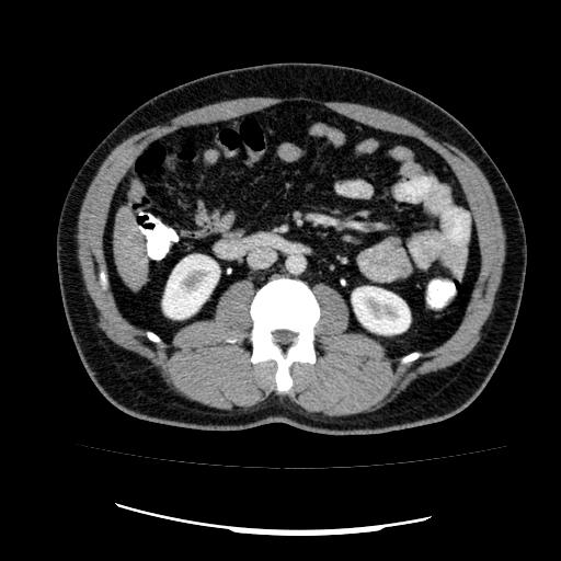 File:Appendicitis with diverticulosis (Radiopaedia 47693-52383 Axial C+ 66).jpg