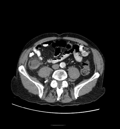 Appendicitis with localized perforation and abscess formation (Radiopaedia 49035-54130 A 59).jpg