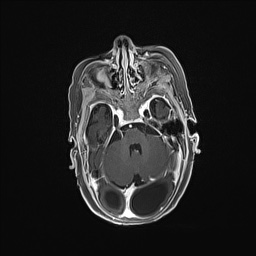 Aqueductal stenosis (Radiopaedia 73974-84802 Axial T1 C+ 56).jpg