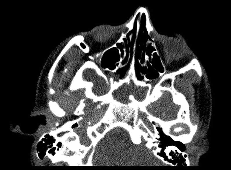 File:Arachnoid cyst- extremely large (Radiopaedia 68741-78450 Axial bone window 5).jpg