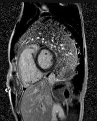 File:Arrhythmogenic right ventricular cardiomyopathy (Radiopaedia 57972-64966 D 5).jpg
