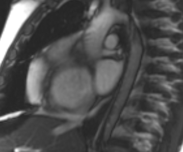 Arrhythmogenic right ventricular cardiomyopathy (Radiopaedia 69431-79307 Short axis cine 243).jpg