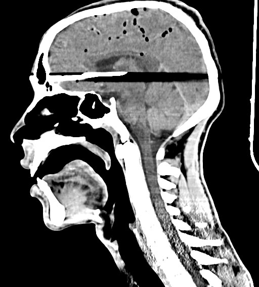 Arrow injury to the brain (Radiopaedia 72101-82607 H 33).jpg