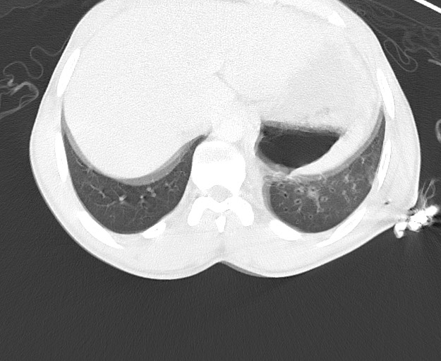 File:Arrow injury to the chest (Radiopaedia 75223-86321 Axial lung window 88).jpg