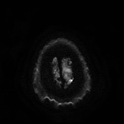 File:Artery of Percheron infarct (Radiopaedia 48088-52928 Axial DWI 30).jpg