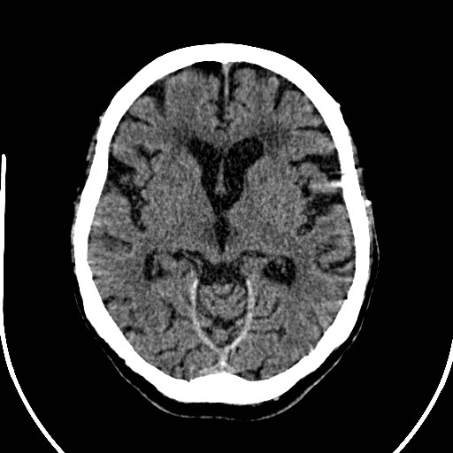 File:Artery of Percheron infarction (Radiopaedia 26307-26438 Axial non-contrast 14).jpg