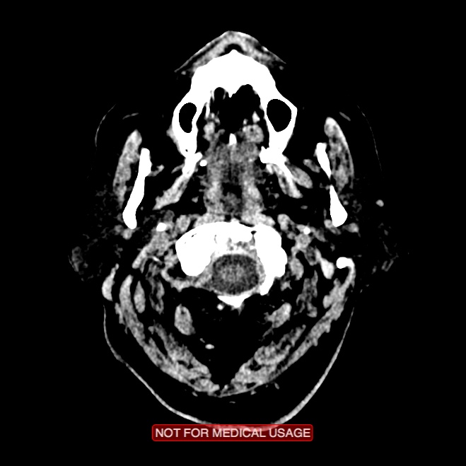 Artery of Percheron infarction (Radiopaedia 28679-28967 Axial non-contrast 1).jpg