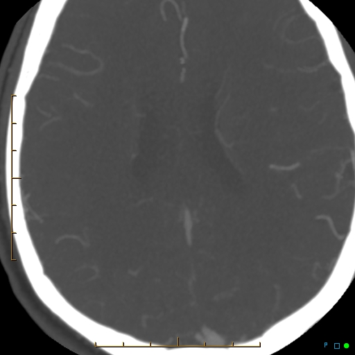 File:Artifactual basilar artery stenosis due to metallic stent (Radiopaedia 31206-31923 A 29).jpg