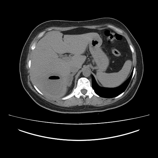 Ascending retrocecal appendicitis with liver abscesses (Radiopaedia 60066-67615 Axial non-contrast 21).jpg